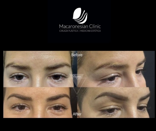 Reconstrucci&oacute;n de cejas y camuflaje de cicatriz con micropigmentacion