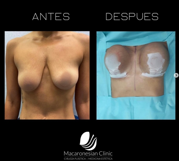 Mastopexia en T invertida con pr&oacute;tesis redondas 265 CC