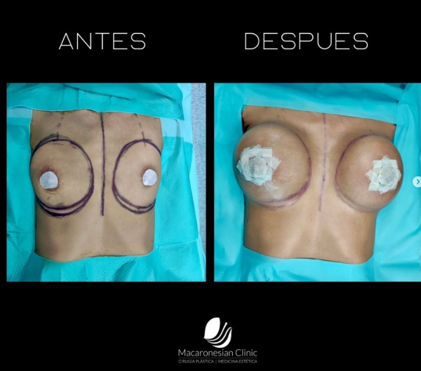 Mamoplastia de aumento con pr&oacute;tesis 425CC ergon&oacute;micas,