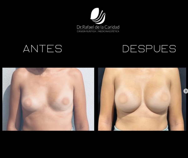 MamoplastIa de aumento con pr&oacute;tesis Ergon&oacute;micas