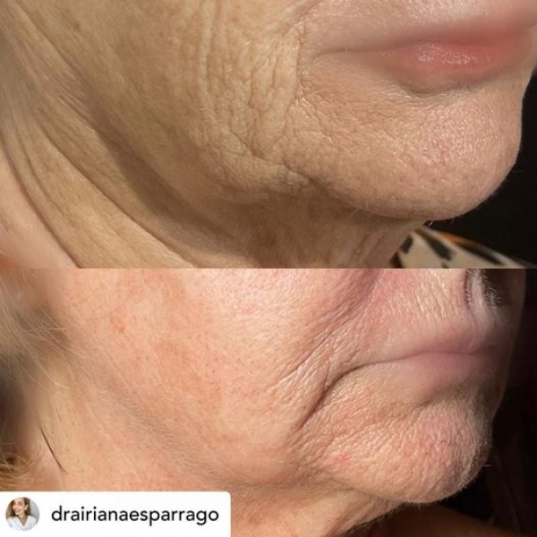 Tratamiento facial con Morpheus8